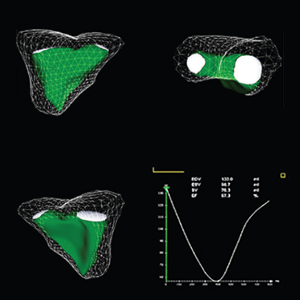 RV ESV (Right ventricular end-systolic volume)