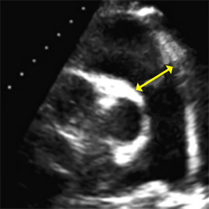 RVOT distal PSAX (Right ventricular outflow tract dimension at distal)
