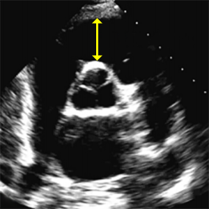 RVOT prox PSAX (Right ventricular outflow tract dimension at proximal