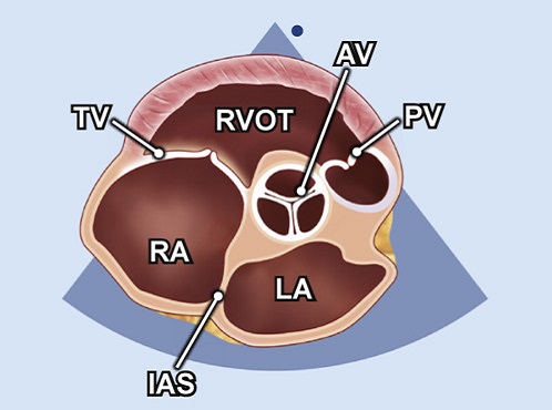 Echocardiography view: PSAX (level great vessels) focus on AV, Window: Left parasternal window