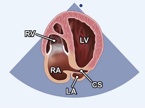 Echocardiography view: A4C posterior angulation, Window: Apical window