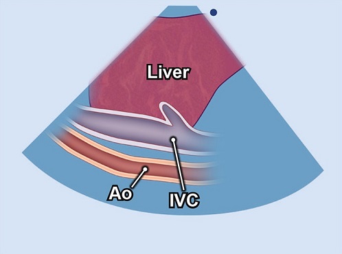 Echocardiography view: Right lateral IVC, Window: Subcostal window