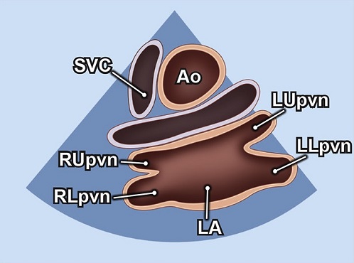 Echocardiography view: SSN (Suprasternal notch), Window: Suprasternal notch