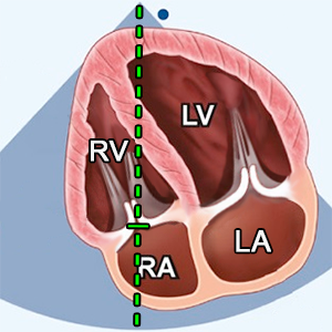 Apical 4 chamber (A4C). Tricuspid valve CW doppler