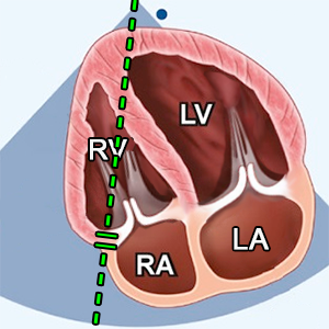 A4C (Apical 4 chamber), PW doppler, lateral tricuspid annulus