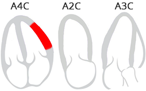 Lateral Infarct (Echocardiography segments)