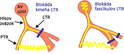 Site of LBBB main trunk, or block of both left fascicles