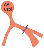 Heart conduction system incomplete left bundle branch block (iLBBB)