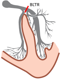 Heart electrical conduction system, left bundle branch block (LBBB)
