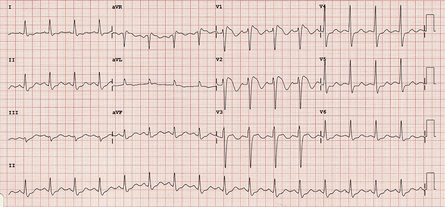 ECG Brugada syndrome (Type I), RSR pattern (V1), mimicking RBBB