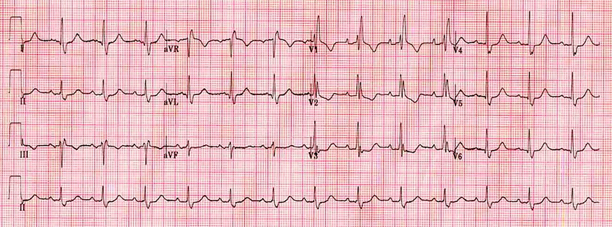 ECG criteria complete RBBB, broad QRS, M-shaped V1, Wide slurred s wave lateral leads (I, aVL, V5-V6)