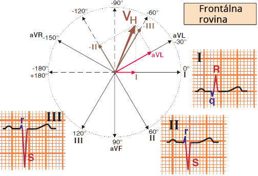 ECG quick diagnosis of left anterior hemiblock (LAH), Positive I lead, Negative II III leads, narrow QRS complex