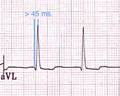ECG left anterior hemiblock (LAH), R peak time in lead aVL of 45ms or more