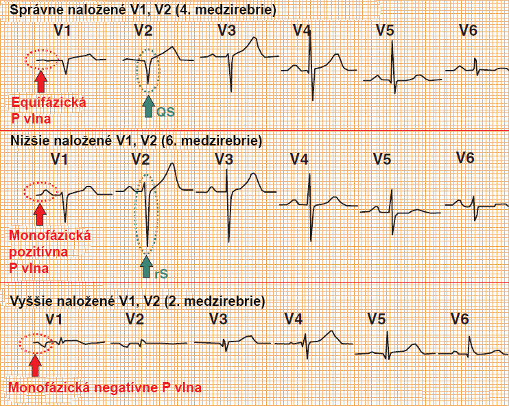 ECG orroneous diagnosis of anteroseptal myocardial infarction, Left anterior hemiblock (LAF)
