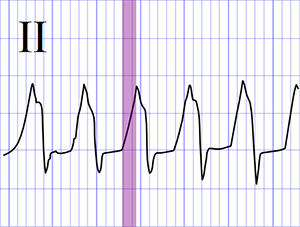 ECG ventricular tachycardia, The R Wave Peak Time (RWPT)
