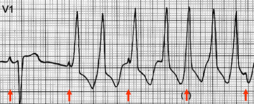ECG ventricular tachycardia, av dissociation (P and QRS complexes at different rates)