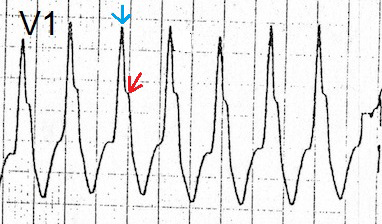 ECG ventricular tachycardia, RBBB pattern, left rabbit ear (Rsr)