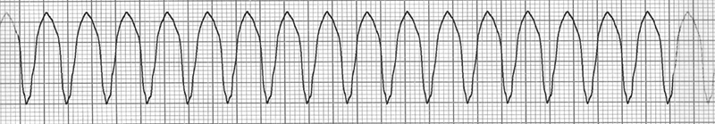 ECG ventricular tachycardia, wide-complex tachycardia