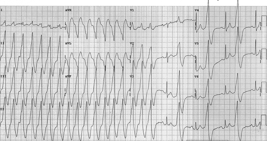 ECG wide-complex tachycardia, ventricular tachycardia, ventricular bigeminy, brugada, sign