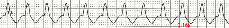 ECG ventricular tachycardia, Very broad QRS complexes (160ms)