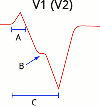 ECG ventricular tachycardia (V1), Absence of typical LBBB morphology