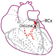 Isolated Posterior Wall Myocardial Infarction, distla RCx occlusion