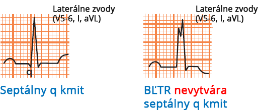 LBBB and septal Q wave