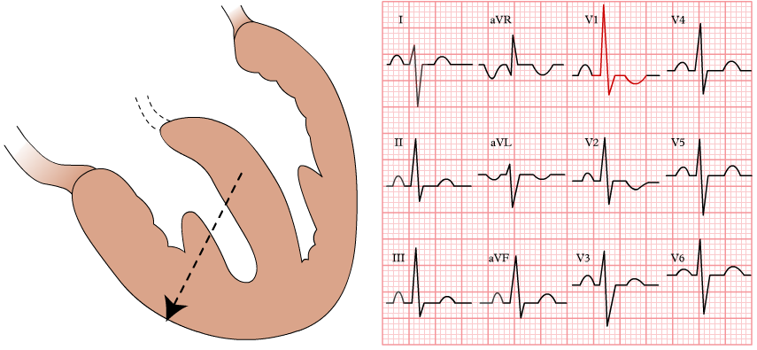 ECG right ventricular hypertrophy, voltage criteria, Right axis deviation, Dominant R wave in V1, Dominant S wave in V5 or V6