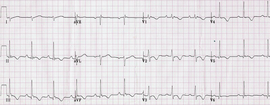 ECG right ventricular hypertrophy (RVH), arrhythmogenic right ventricular cardiomyopathy, dyplasia (ARVD), Right axis deviation, R S ratio